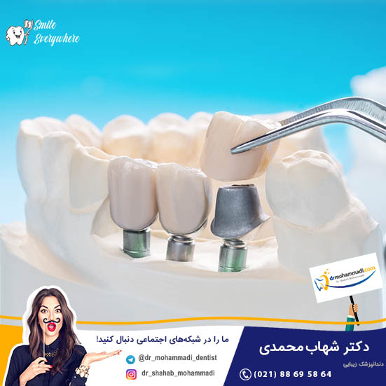 تعداد جلسات حضور در کلینیک برای ایمپلنت دندان چه تعداد است و هر جلسه چقدر طول می کشد؟ - کلینیک دندانپزشکی دکتر شهاب محمدی